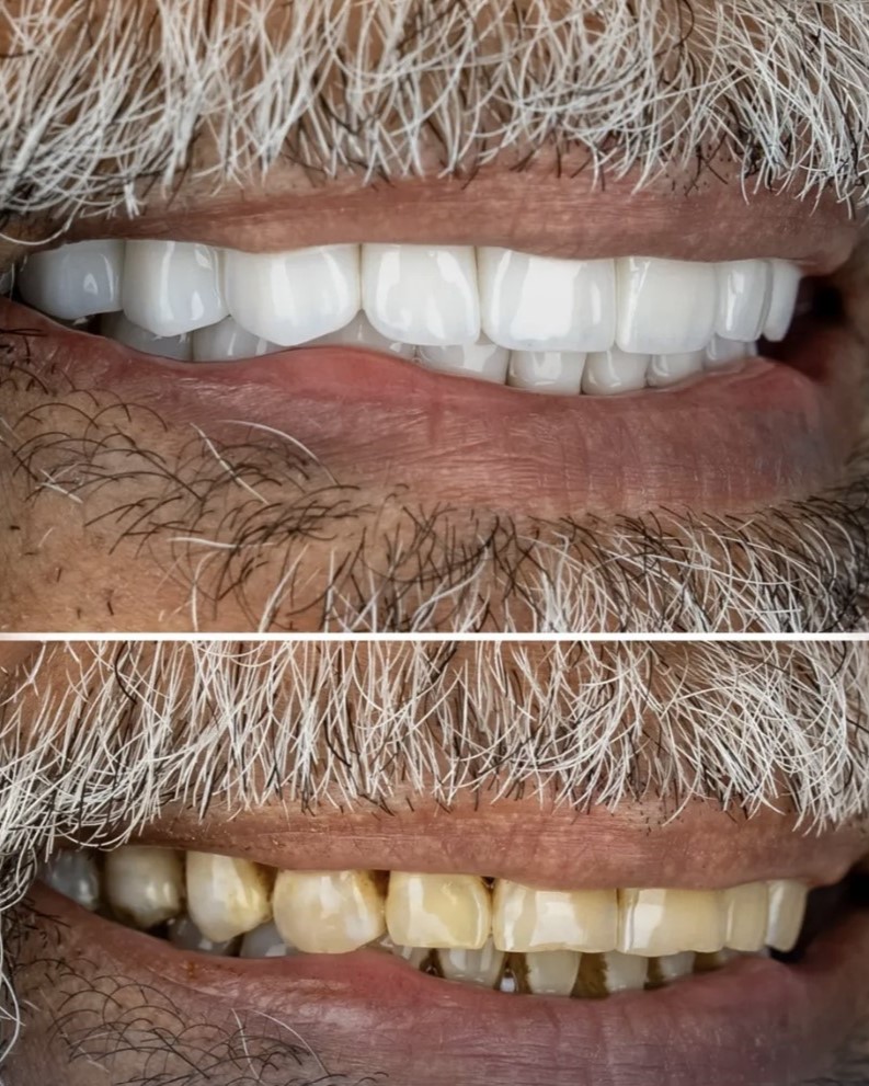 Smile transformation 2